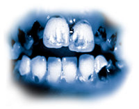 Gli ingredienti tossici contenuti nel meth portano al grave deterioramento dei denti chiamato “bocca da meth”. I denti diventano neri, macchiati e cariati spesso fino al punto di dover essere estratti. I denti e le gengive vengono distrutti dall’interno e le radici  si cariano.